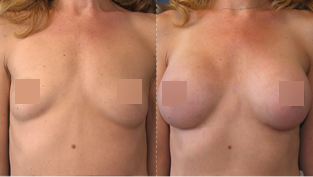 Breast  Augmentation