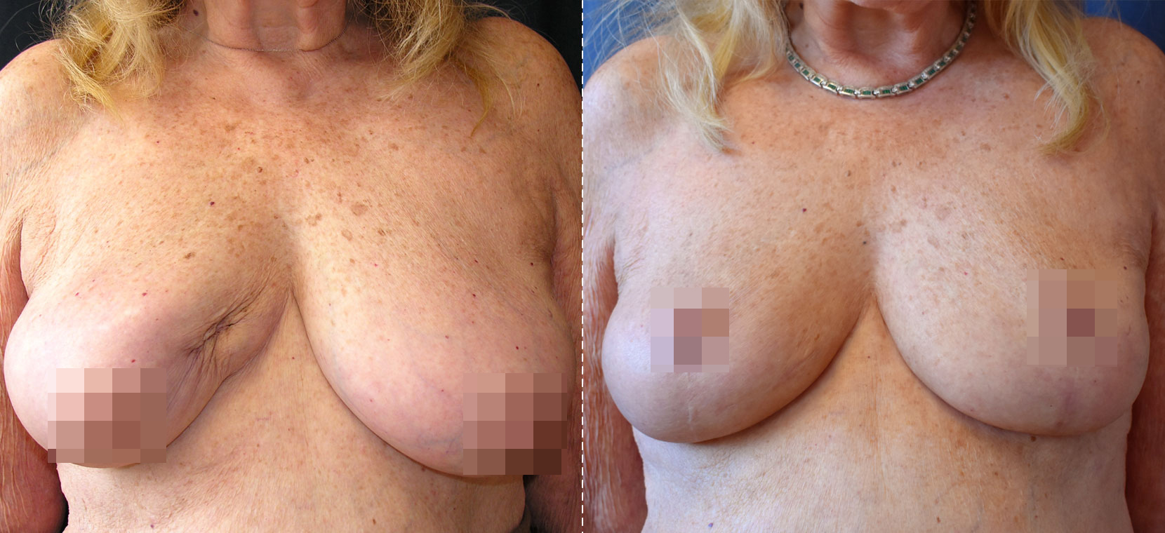 Breast Reconstructive Oncoplastic