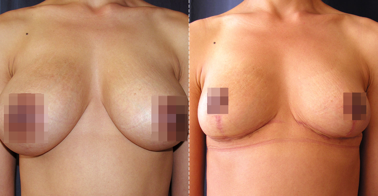 Breast Reduction (Reduction Mammaplasty)