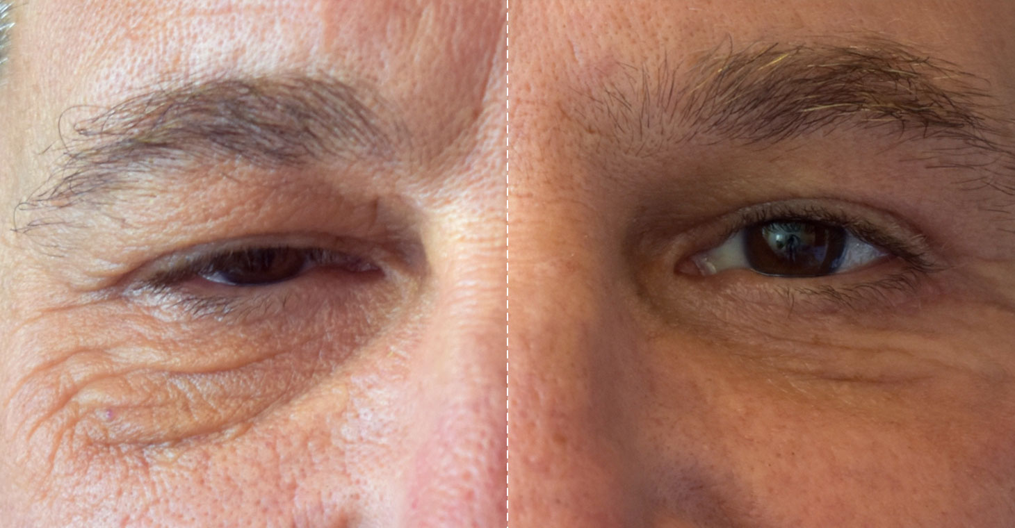 Eyelid Surgery (Blepharoplasty)