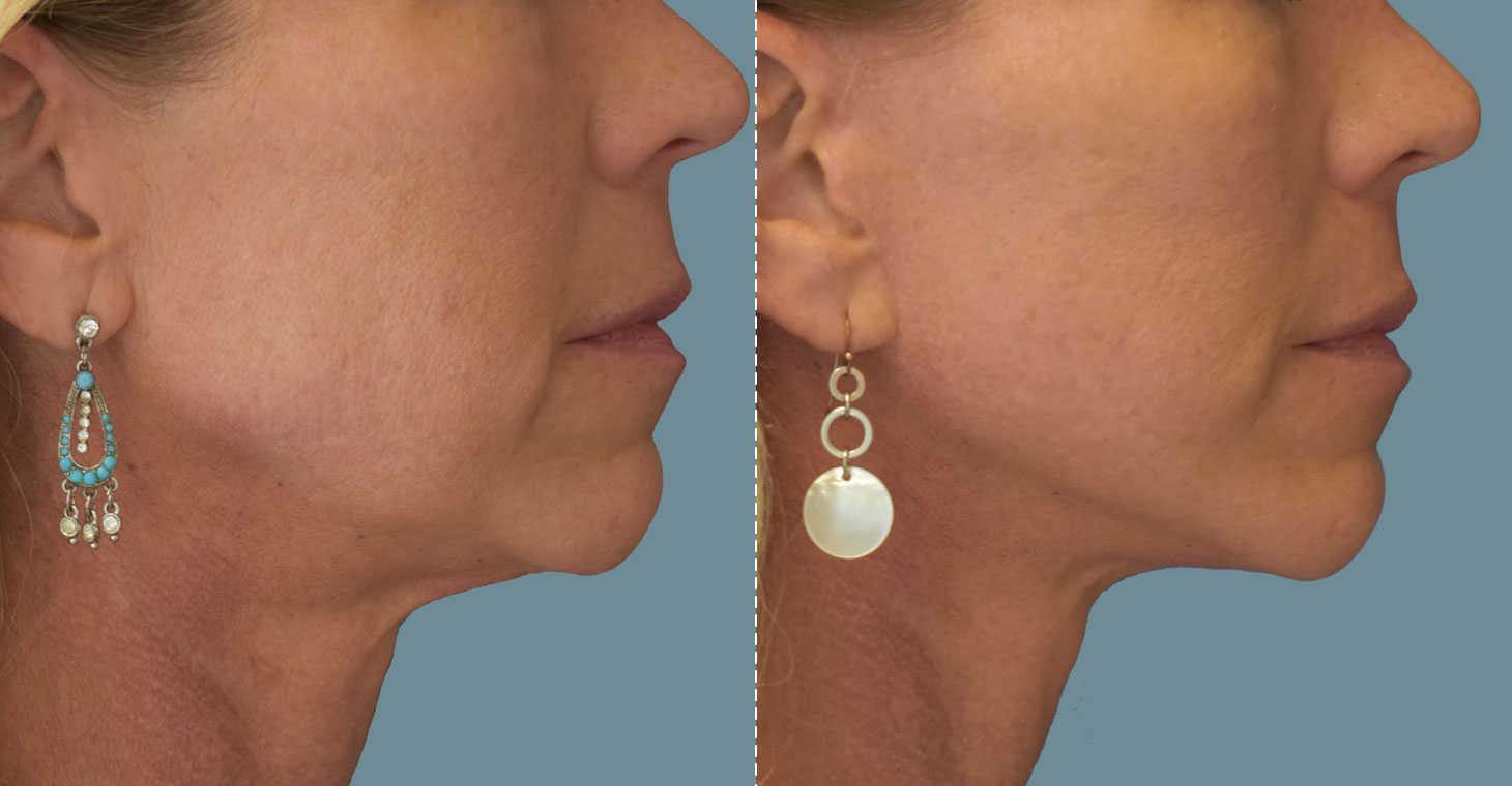 Facelift/Necklift (Rhytidectomy)