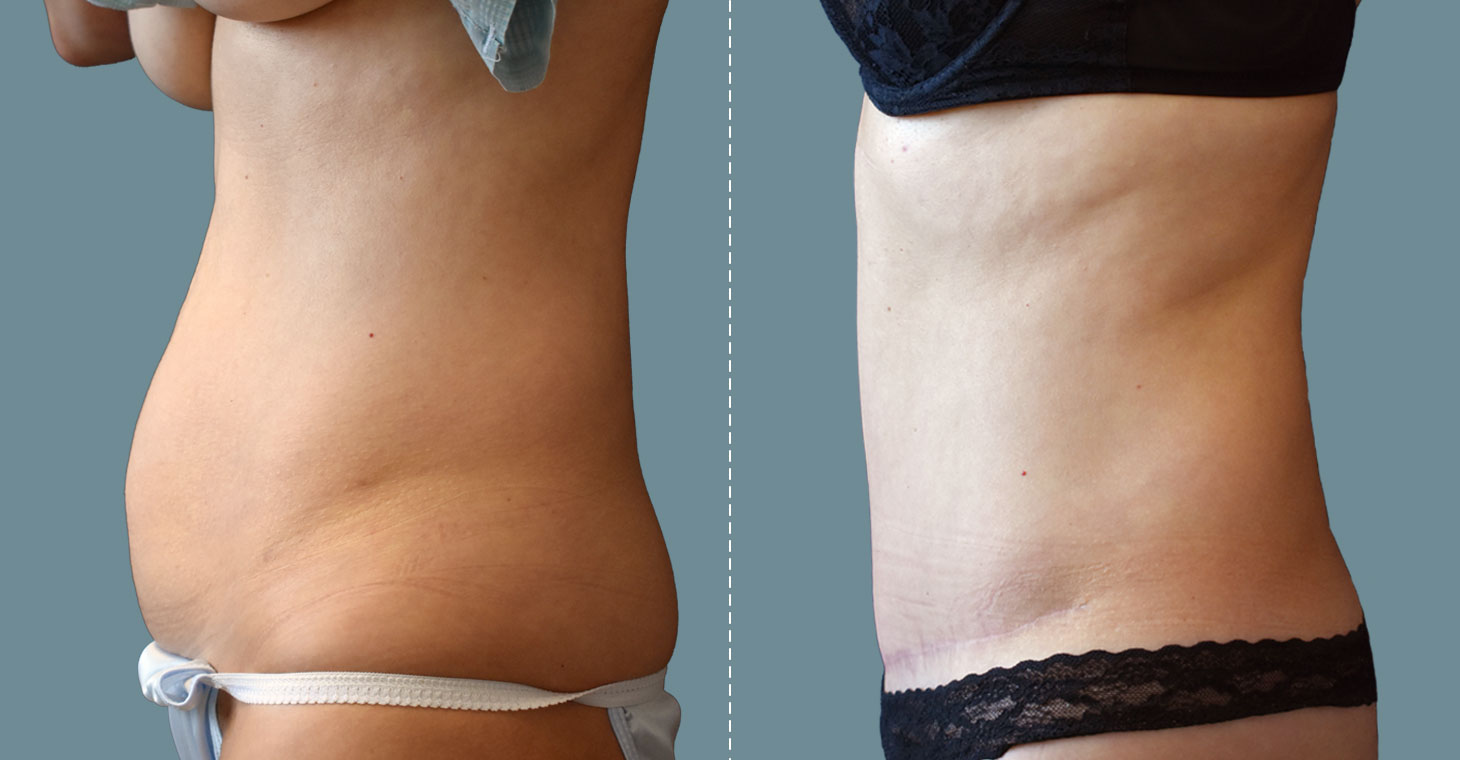Tummy Tuck (Abdominoplasty)