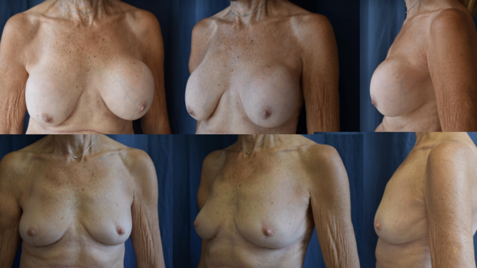 Breast Implant Removal Patient