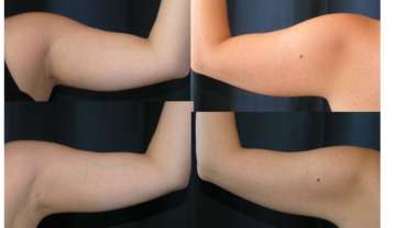 Liposuction – Charlotta La Via